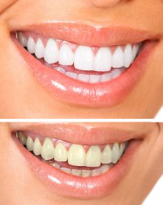 Tooth Whitening