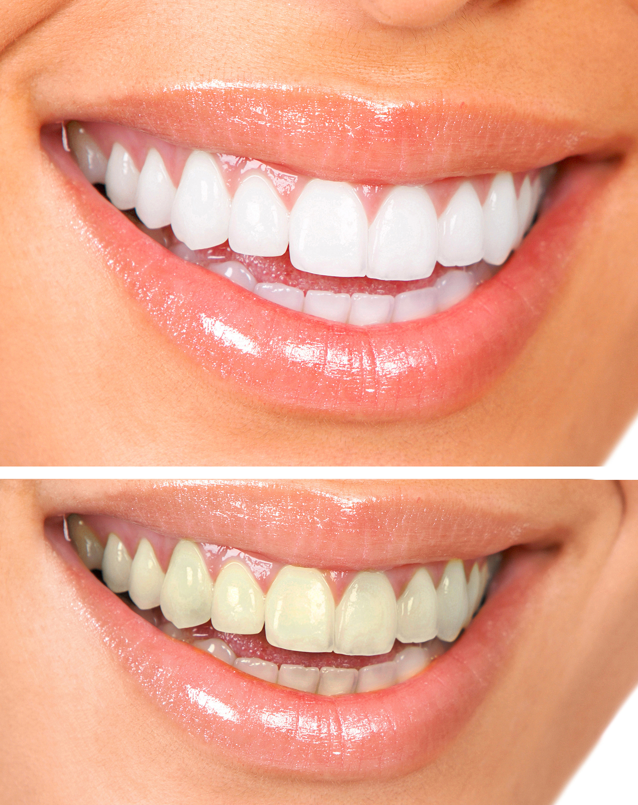 laser teeth whitening houston