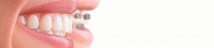Aligner Braces